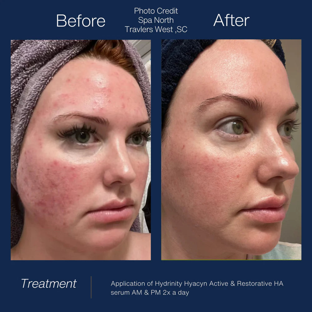 Restorative HA Serum