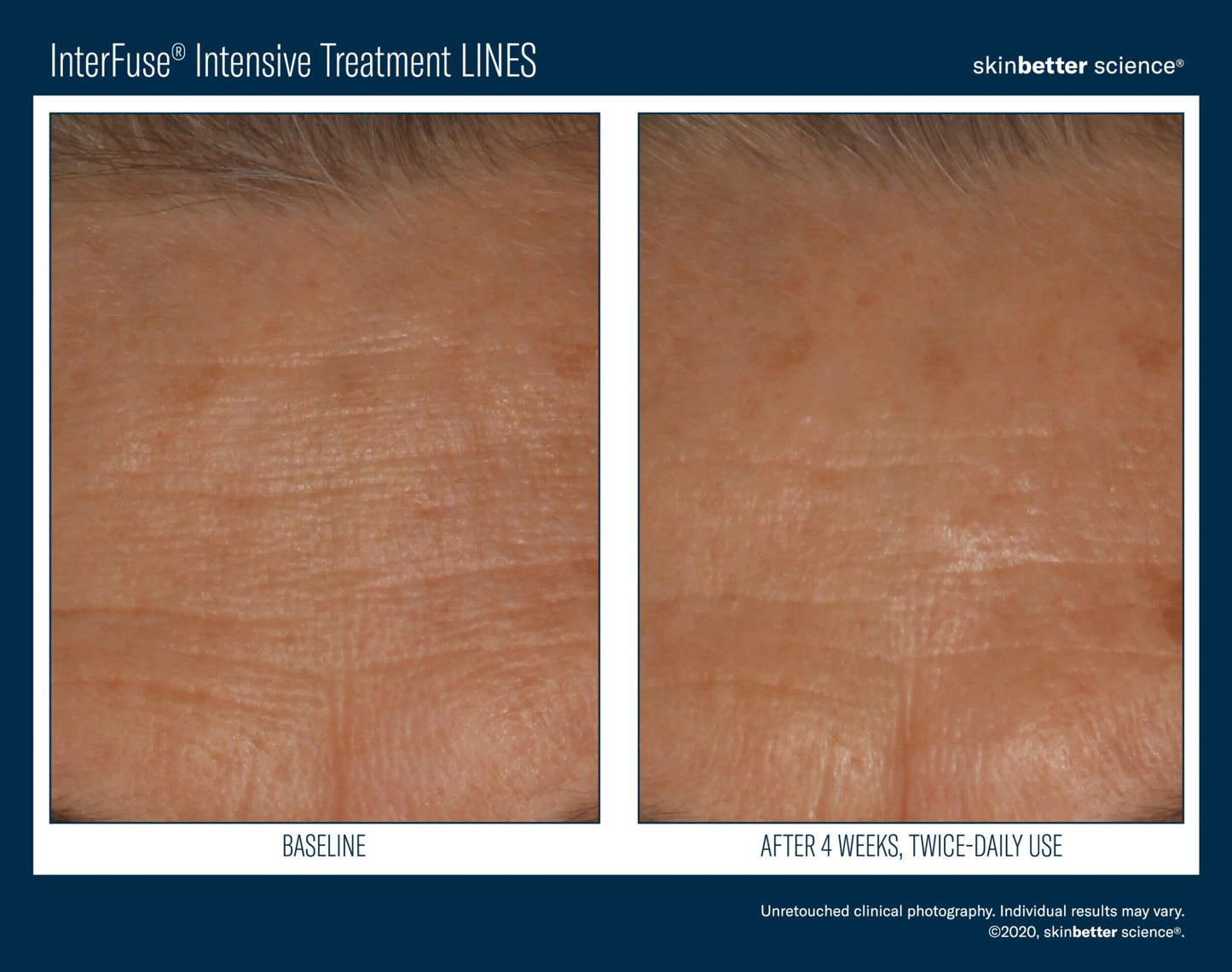 InterFuse Intensive Treatment LINES