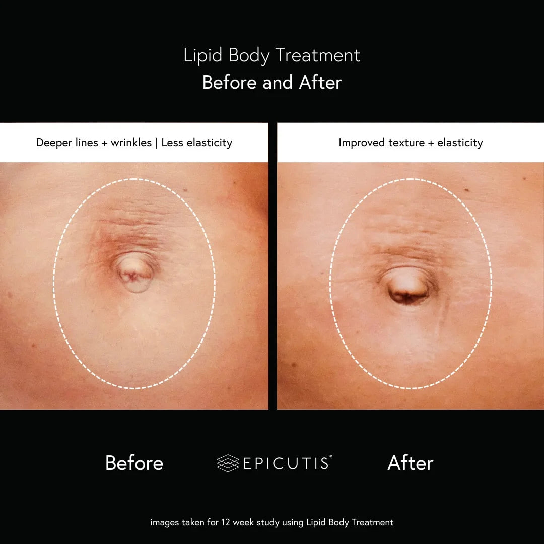Lipid Body Treatment