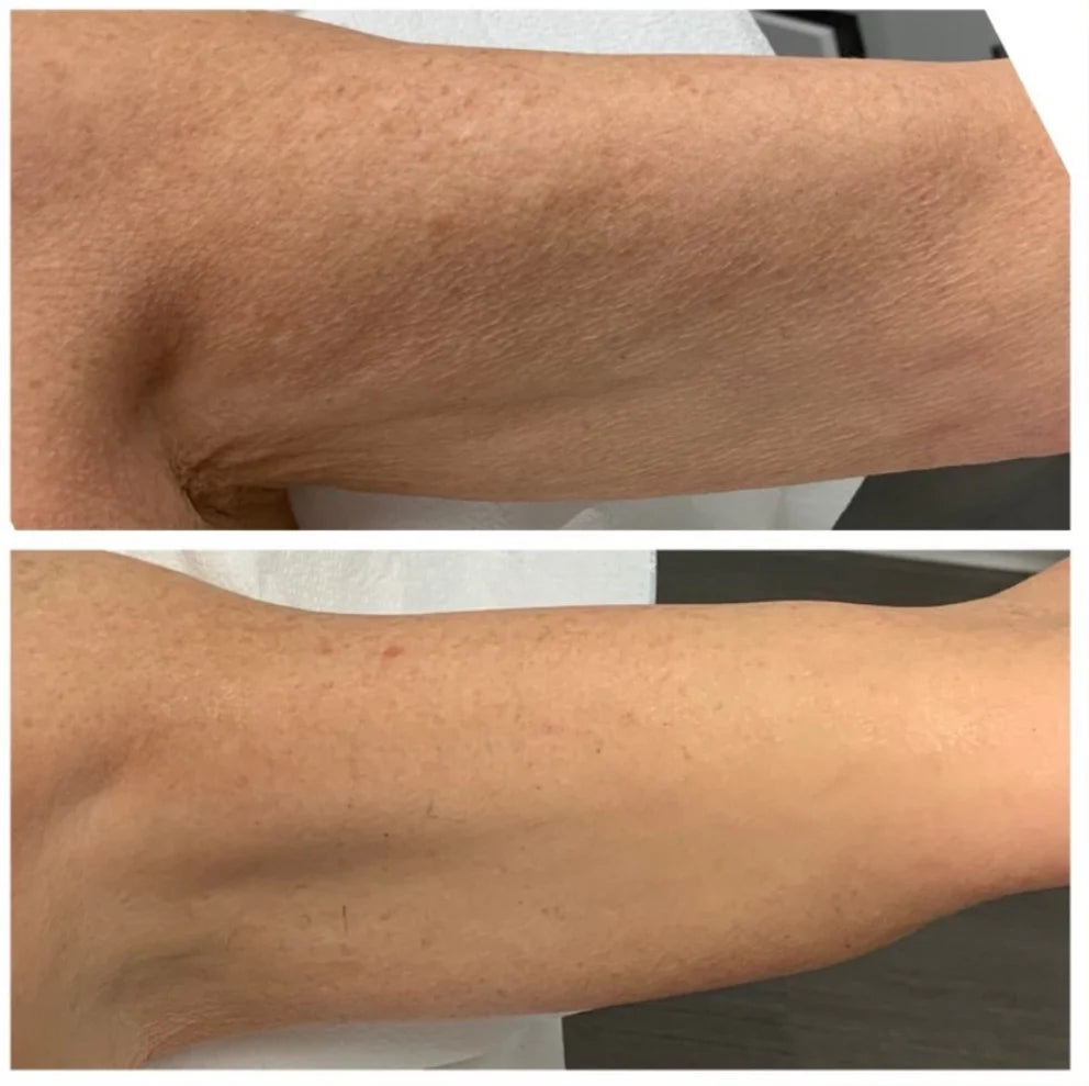 Lipid Body Treatment
