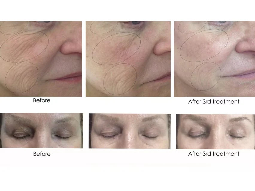 CO2 Lift Pro Treatment