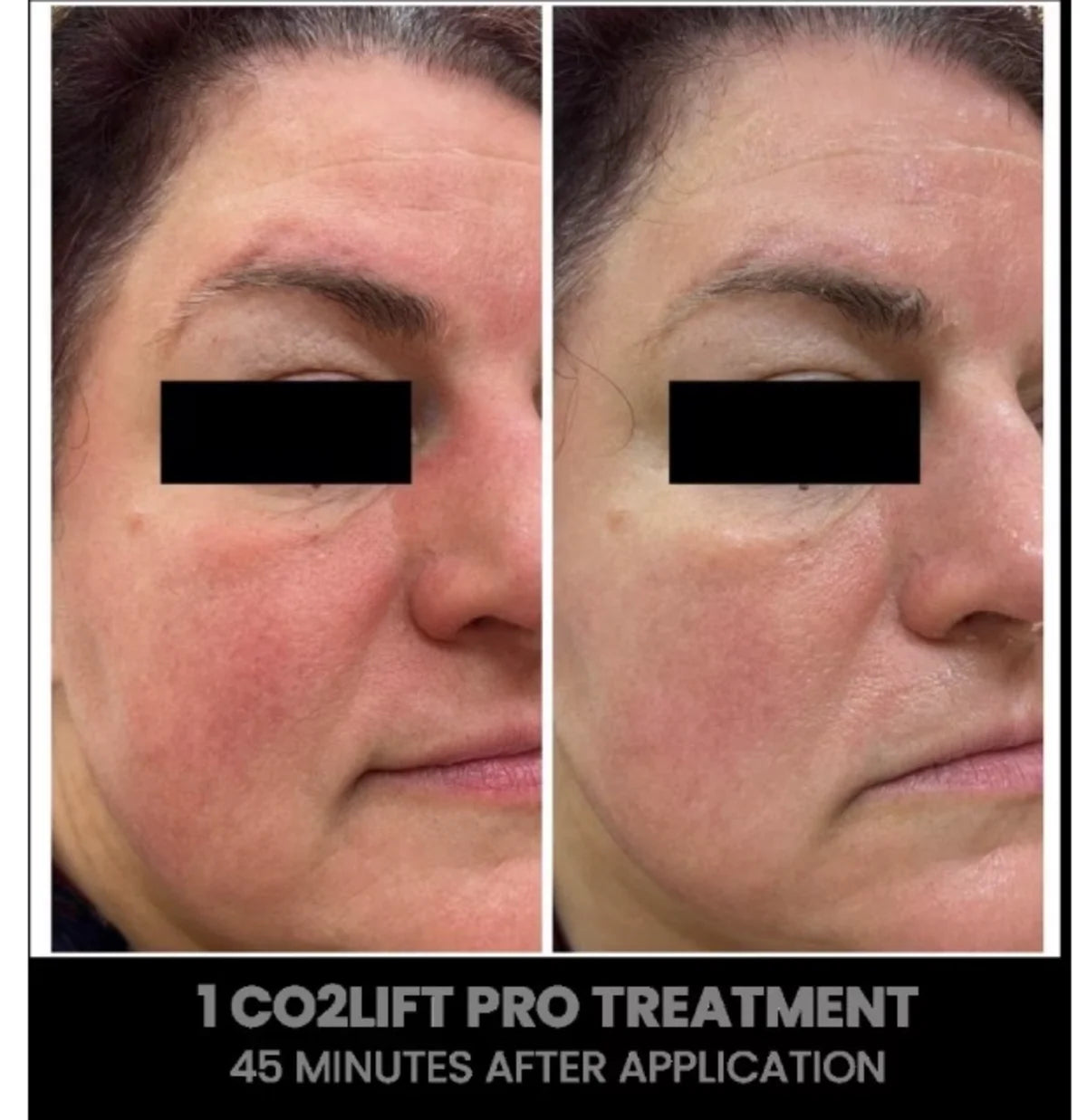 CO2 Lift Pro Treatment
